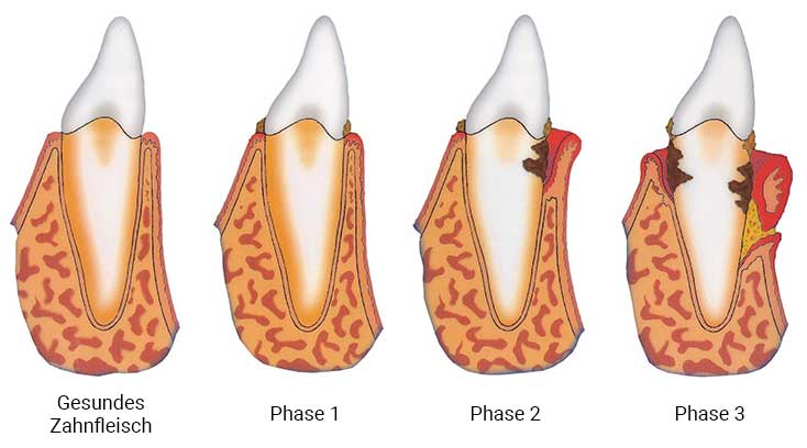 Dr-Graboswki-Zahnarzt-Amberg-Weiden-Parodontologie-Parodontose-Behandlung-Phasen-Zahnfleischentzuendung-Infografik-1