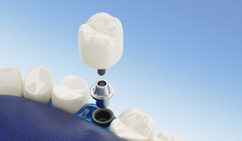 Zahnarzt-Amberg-Hirschau-Dr-Gerd-Grabowski-Implantologie-Implantate-Zahnimplantate-Zahnersatz-so-sehen-Zahnimplantate-aus-Grafik