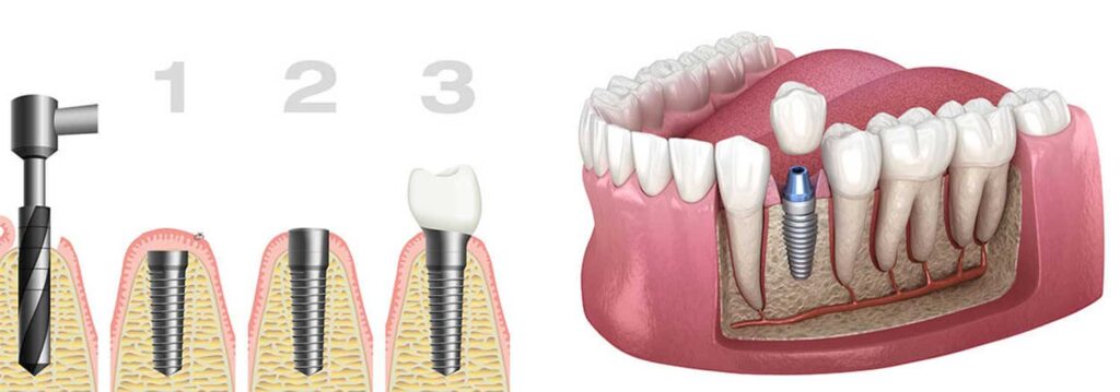 Zahnarzt-Amberg-Hirschau-Dr-Gerd-Grabowski-Implantologie-Implantate-und-Ihre-Moeglichkeiten